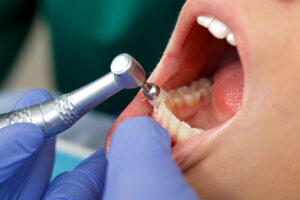 Molar Tooth Decay