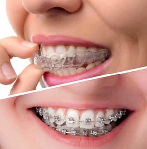 Braces vs Invisalign