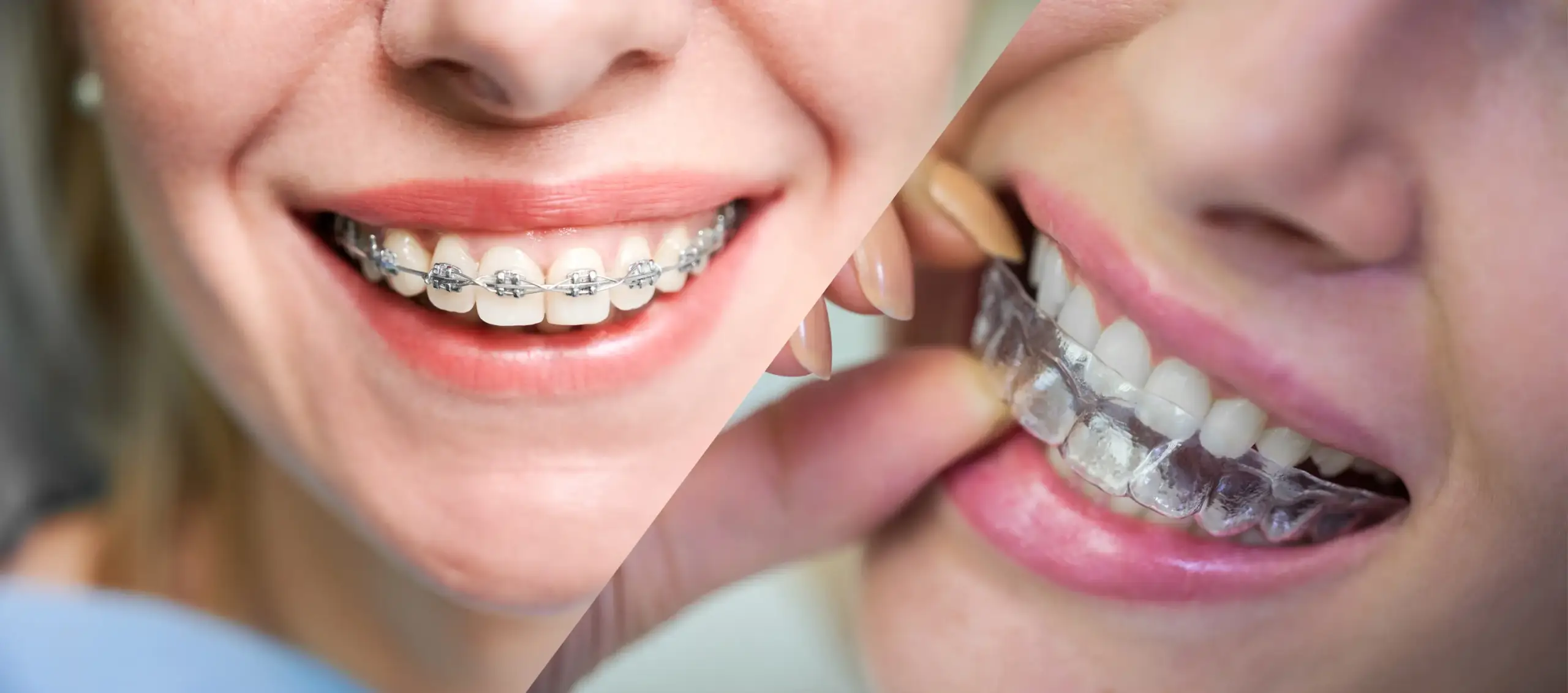 Braces vs Invisalign